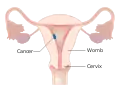 Stage I choriocarcinoma
