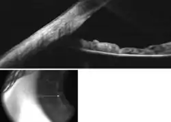 Anterior chamber angle cross-section imaged by an SD-OCT.