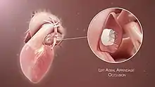 3D Medical Animation still shot of Left Atrial Appendage Occlusion