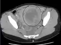 A very large (9&nbsp;cm) fibroid of the uterus which is causing pelvic congestion syndrome as seen on CT