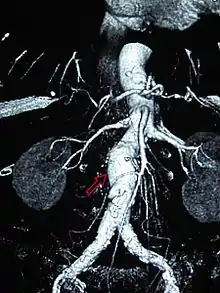 Abdominal aortic aneurysms (3.4&nbsp;cm)