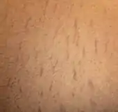 Fuzzy red lines on an abdomen