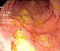 Endoscopic image of Crohn's colitis showing deep ulceration