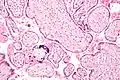Micrograph of a placental infection (CMV placentitis)