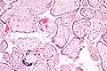 Micrograph of CMV placentitis