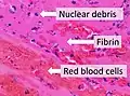 Composition of a fresh thrombus at microscopy, showing nuclear debris in a background of fibrin and red blood cells.