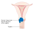Stage 2A cervical cancer