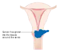 Stage 2B cervical cancer