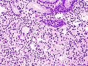 Gastric signet ring cell carcinoma. H&E stain.