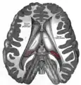 Dissection showing the ventricles of the brain