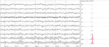 Human EEG with prominent alpha-rhythm