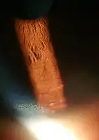 Copper deposition on corneal Descemet's membrane