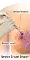 Needle breast biopsy