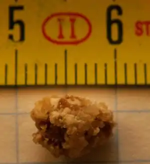 A color photograph of a kidney stone, 8 millimetres in length.