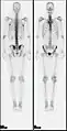 A nuclear medicine whole body bone scan. The nuclear medicine whole body bone scan is generally used in evaluations of various bone-related pathology, such as for bone pain, stress fracture, nonmalignant bone lesions, bone infections, or the spread of cancer to the bone.