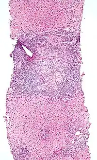 Low-magnification micrograph of PBC, H&E stain