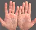 Psoriasis of the palms