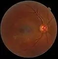 A fundus photograph showing the macula as a spot to the left. The optic disc is the area on the right where blood vessels converge. The grey, more diffuse spot in the centre is a shadow artifact.
