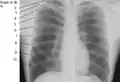 X-ray image of a human chest, with ribs labelled