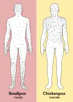 In contrast to the rash in smallpox, the rash in chickenpox occurs mostly on the torso, spreading less to the limbs.