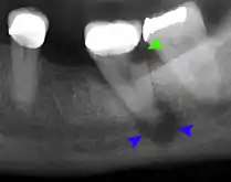 Decay (green) with apical abscess (blue)